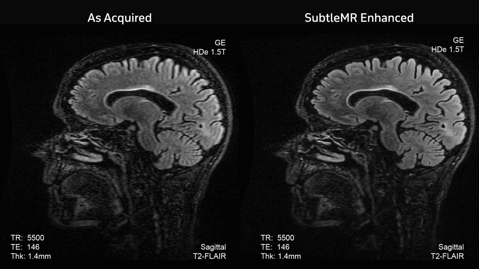 Example: Improving image quality with SubtleMR