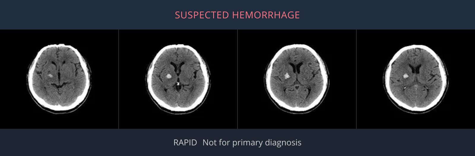 Suspected hemorrhage